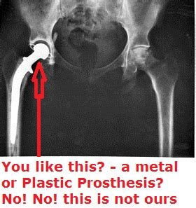 10+ Hip Replacement Risks (50,000 metal hip replacement patients RECALLED to hospital) – Chinese ...