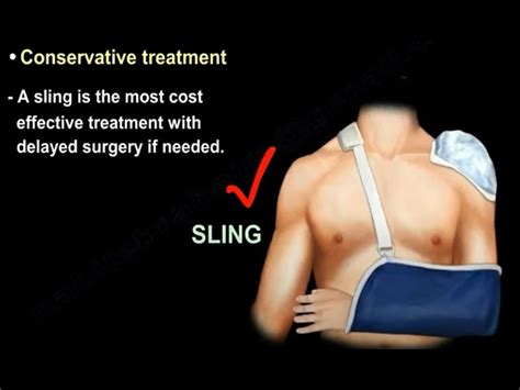 Clavicular Fracture