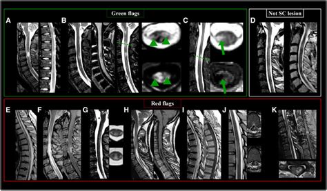 Lesions On Mri T Spine