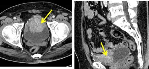 Synchronous Urinary Bladder And Prostate Cancer Radiology Cases