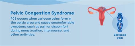 Pelvic Congestion Syndrome What Is Pelvic Congestion Syndrome