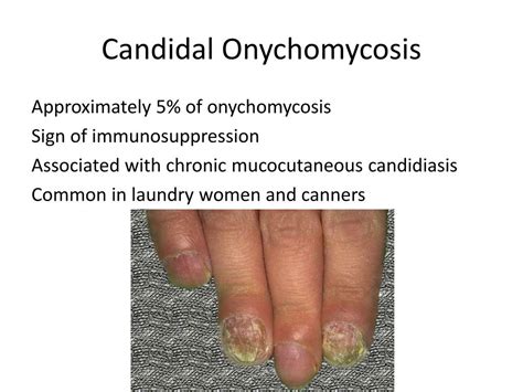 Chronic Mucocutaneous Candidiasis Nails