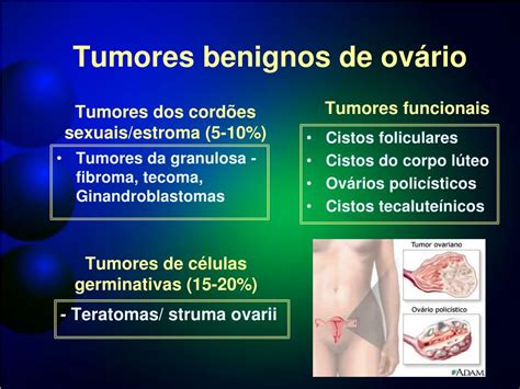 Tumores Benignos Y Malignos De Ovario