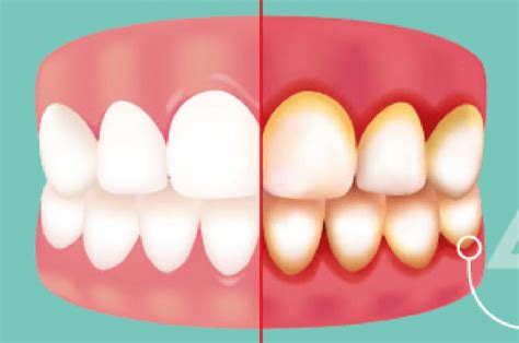 Gingivitis Algodones Dentists Guide