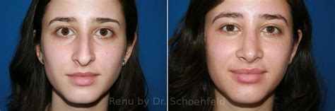 Rhinoplasty Photos | Chevy Chase, MD | Patient 9517