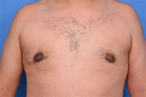 Gynecomastia Surgery Before After Patient Agc