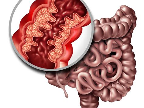 Inflammatory Bowel Disease Treatment And Management