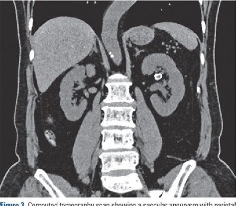 Figure 1 From Calcified Intrarenal Aneurysm Simulating Urinary