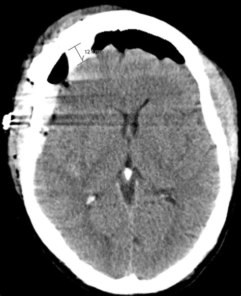 Right Modified Orbitozygomatic Craniotomy For Acomm And Mca Aneurysms