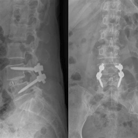 Postoperative Anteroposterior And Lateral Lumbar Radiographs Using Srt Download Scientific Diagram