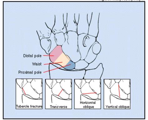 Scaphoid Fracture Cast Time