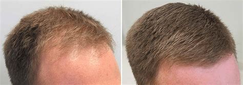 Finasteride Before and After Photos [2025]