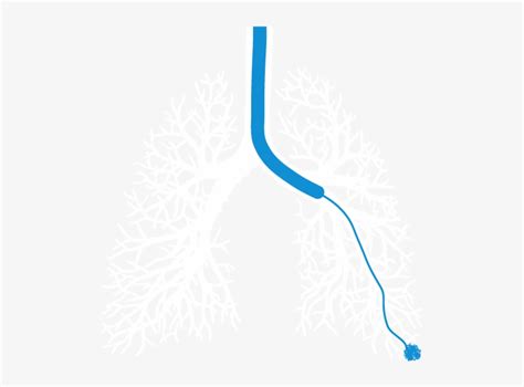 Bronchoscopy - Electromagnetic Navigation Bronchoscopy Biopsy ...