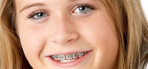 How Soon Should Your Pre Teen See The Orthodontist Oakville Dental