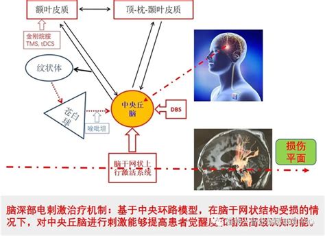 长期昏迷患者促醒的个体化治疗 脑医汇 神外资讯 神介资讯