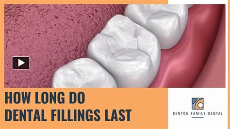 Ppt Understanding Dental Fillings How Long Do They Last 1