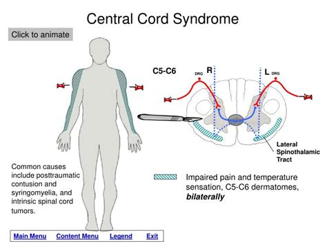 Ppt Lesions Of The Spinal Cord Powerpoint Presentation Id1265796