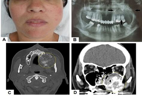 Calcifying Epithelial Odontogenic Tumor Radiography