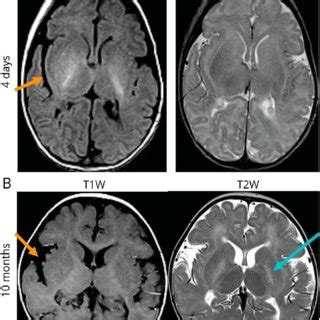 Brain Mri Of Patient Shows Corpus Callosum Dysgenesis And Loss Of