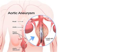 Symptoms help in the Diagnosis of an Abdominal Aortic Aneurysm