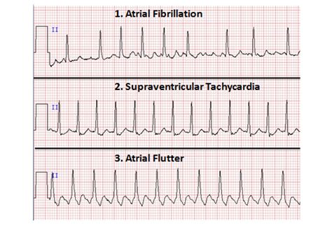 Atrial Fibrillation: Atrial Fibrillation Diagnostic Tests