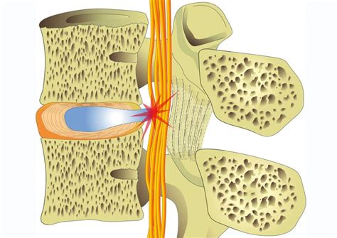 Bandscheibenvorwölbung Was ist Bulging Protrusion