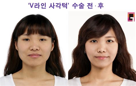 ‘v라인 사각턱수술로 부정적인 인상 교정 Bnt뉴스