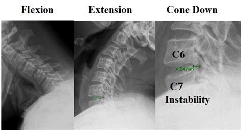 Flexion X Ray Cervical Spine Doctorskoti