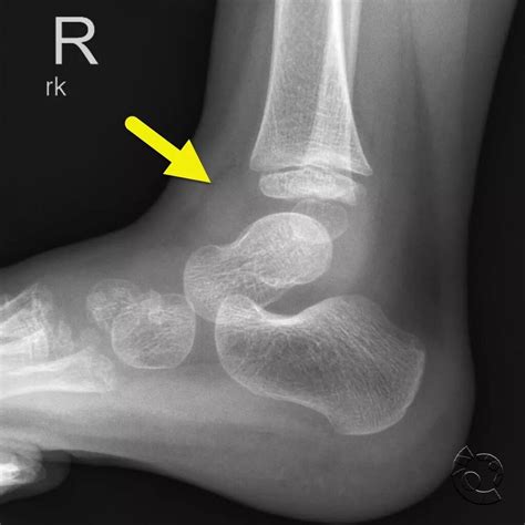 Ankle Effusion X Ray