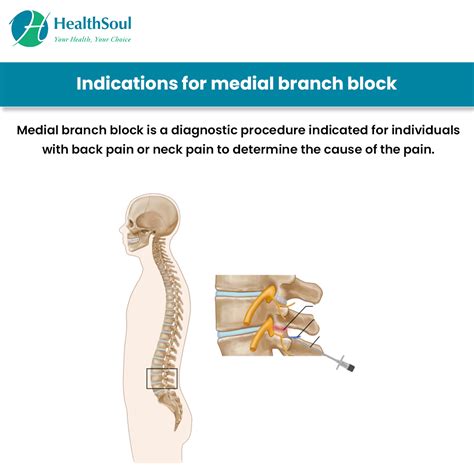 Medial Branch Block Procedure