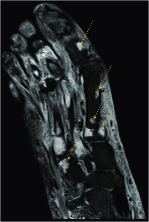 Mri Of The Right Foot Shows Diffuse Soft Tissue Swelling With Mild Download Scientific Diagram