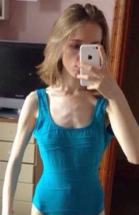 Teenager Who Starved Herself To Look Like Singer Cheryl Shrunk To Only