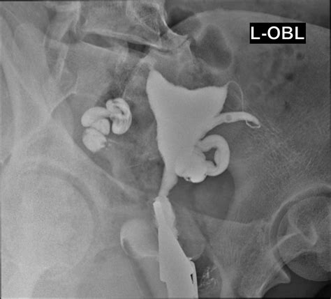 Bilateral Hydrosalpinx And Venous Intravasation Image Radiopaedia Org