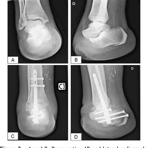 Figure 2 From Technique And Early Experience With Posterior