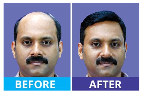 Hairfixing Kottayam - Gateway Hair Fixing