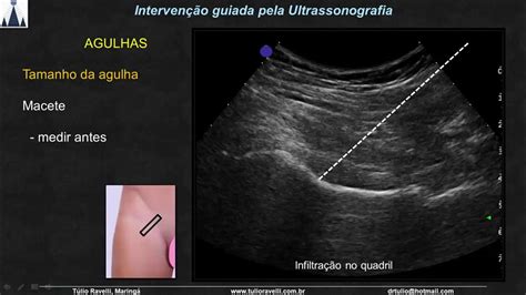 Curso De Intervenção Guiada Pela Ultrassonografia Nos Membros