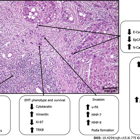 Tumor Budding In Primary Liver Cancers A Tumor Budding Consisting Of