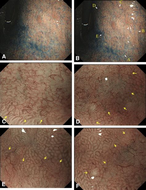 Usefulness Of Magnifying Endoscopy With Narrow Band Imaging For