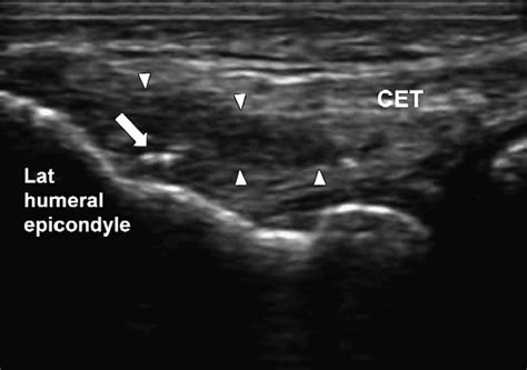 Lateral Epicondylitis Longitudinal Image At The Level Of The Common Download Scientific