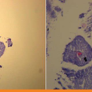 The bronchoscopic biopsy shows organized aggregations of filamentous... | Download Scientific ...