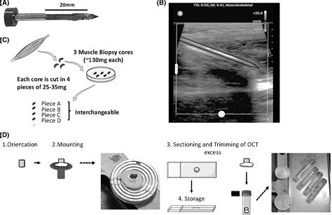 A Welltolerated Core Needle Muscle Biopsy Process Suitable For