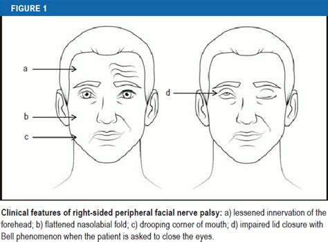 The Diagnosis And Treatment Of Idiopathic Facial Paresis Bells Palsy