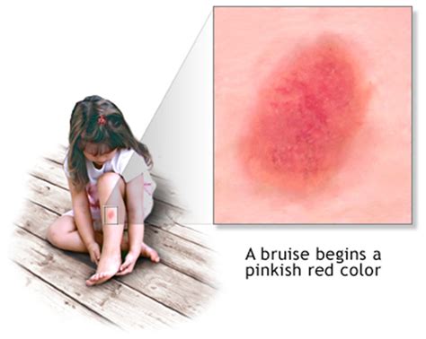 Bruise - Causes, Diagnosis, Treatment, Home Remedy and Healing Time