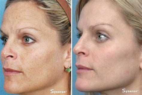 Ipl Photofacial — Baire