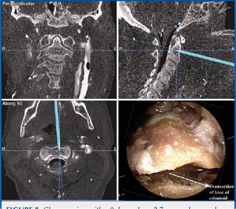 Figure From Endoscopic Imageguided Transoral Approach To The