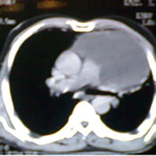 7 Computed Tomography Of A Patient With Thymic Cyst Associated With