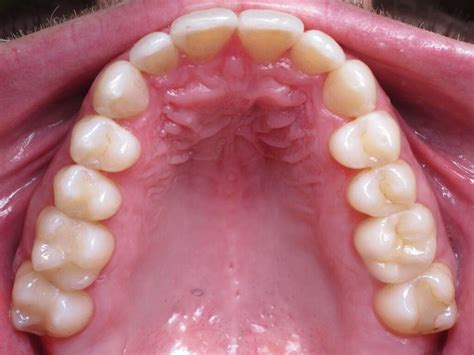 Mouth Cancer 10 Mouth Cancer Symptoms