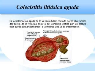 DIAGNOSTICO Y TRATAMIENTO COLECISTITIS AGUDA PPT