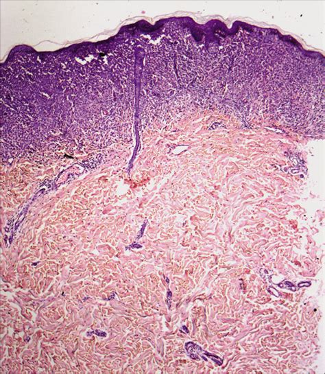 Langerhans Cell Histiocytosis In An Adult Female With Atypical