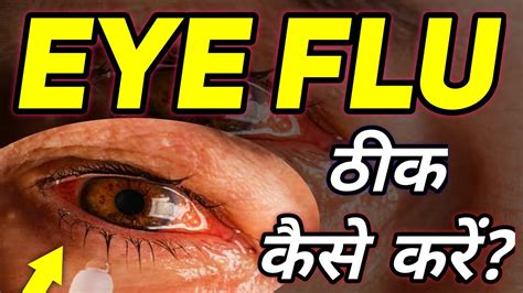 Eye Flu Kaise Hota Hai Eye Flu Hone Par Kya Karen Eye Flu Ke Lakshan Eye Flu Se Kaise